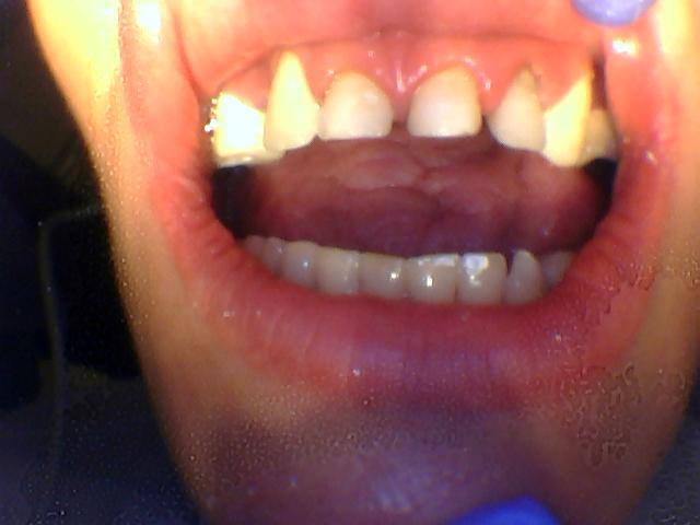 Person with wide gaps between teeth