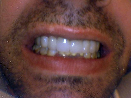 Person with restored teeth