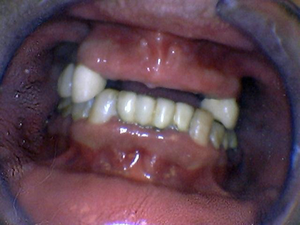 Person with several missing teeth
