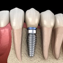 single dental implant post with crown in the lower jaw 