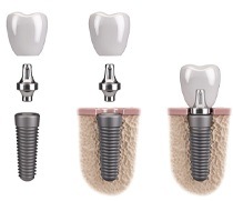 single dental implant post, abutment, and crown being placed in the jaw 