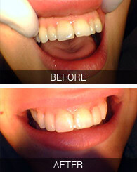 Astoria dental patient before and after photos