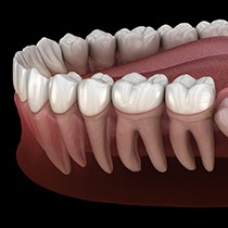 A 3D illustration of an impacted wisdom tooth