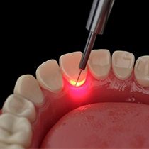 Illustration of dental laser being used on gum tissue