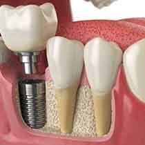 a 3D illustration of a dental implant in the jawbone