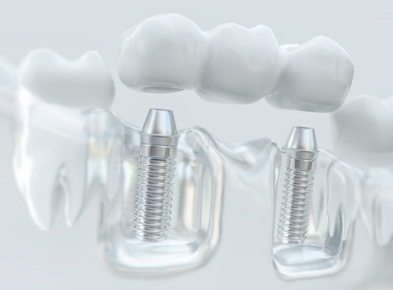 Model of dental implants that support bridge