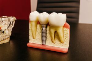 Model of dental implant in dentist’s office